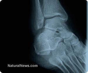 X-Ray-Bones-Broken-Foot-Leg-Scan