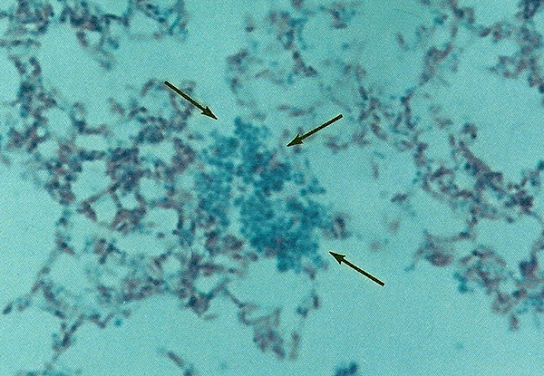 11 Mycobacterium avium immunoblastic lymphoma