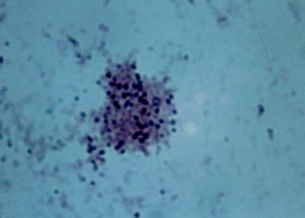 4 Staphylococcus epidermidis breastcancer