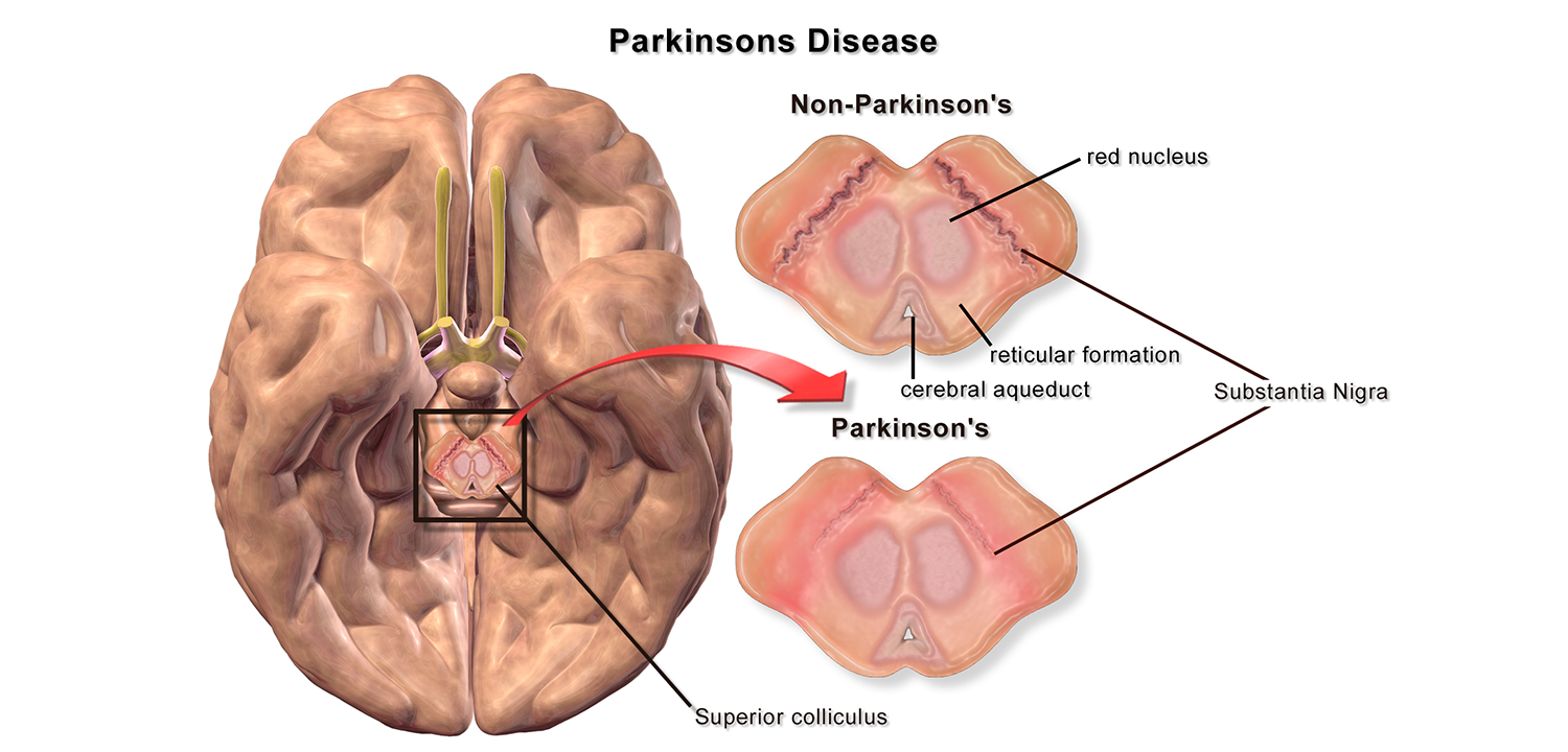 Substantia nigra pars compacta har betydelse för Parkinsons sjukdom. Illustration: Bruce Blaus. Licens: CC BY 3.0, Wikimedia Commons