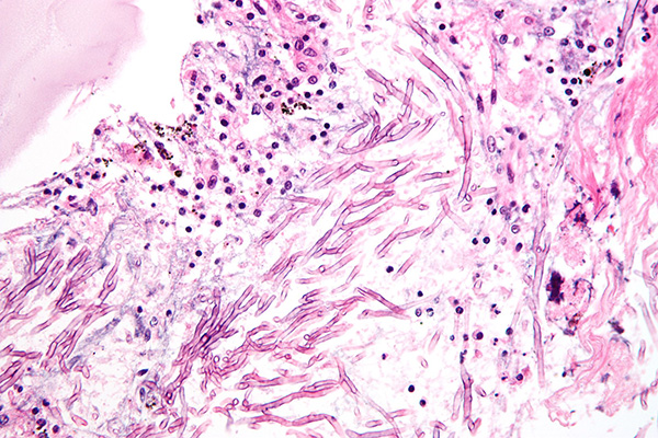 Pulmonary aspergillosis